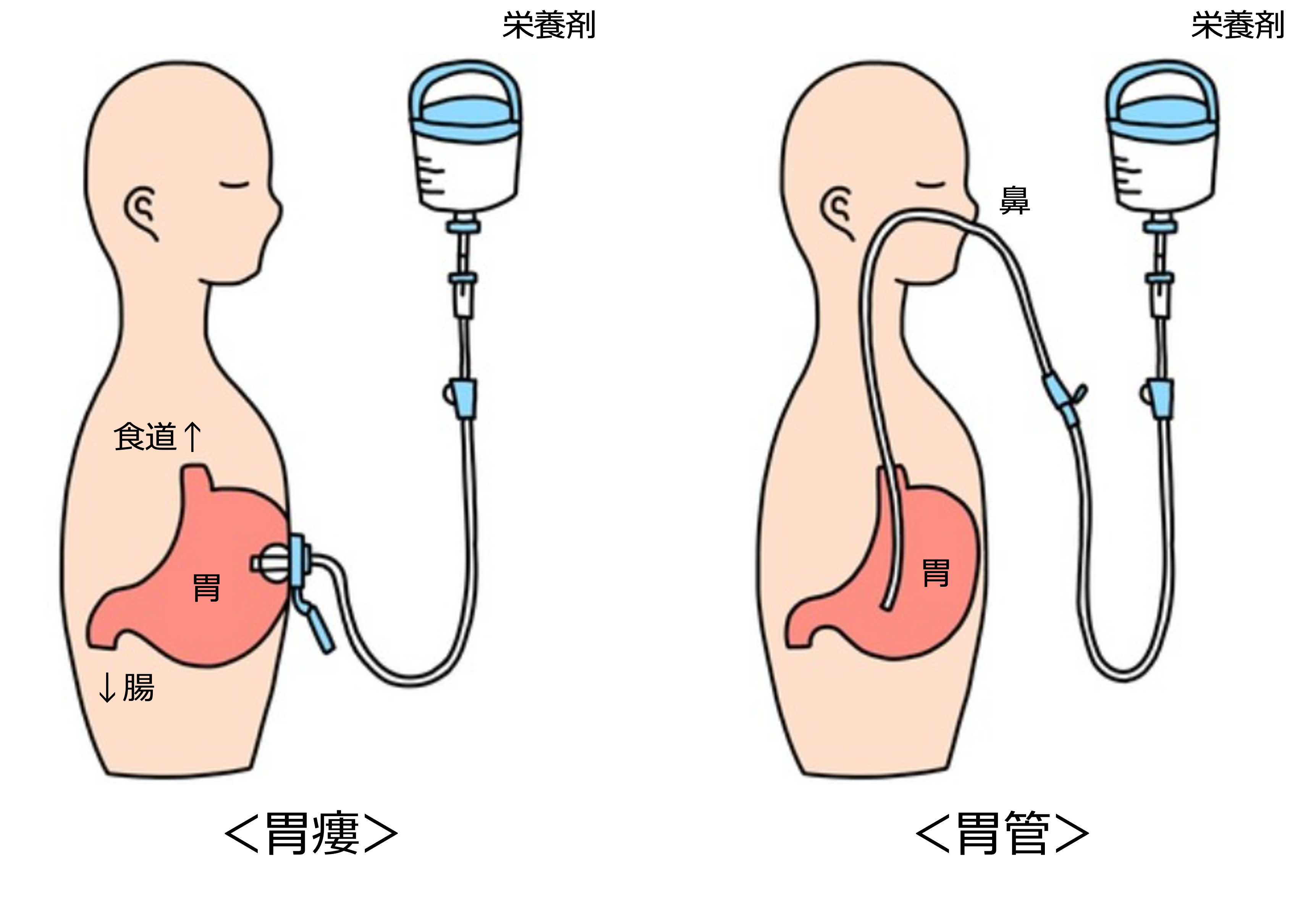 胃瘻と胃管の違いって？ | 松戸まちなかクリニック